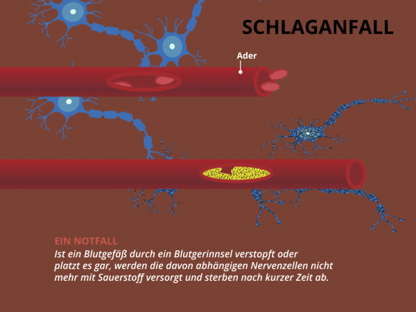 Schlaganfall