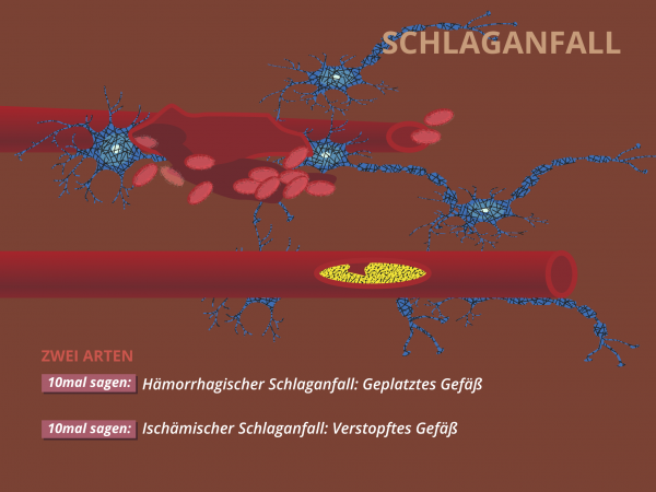 Schlaganfall / Arten
