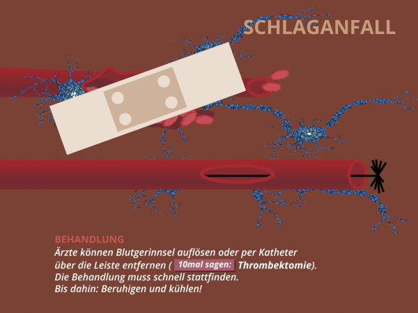 Schlaganfall / Therapie